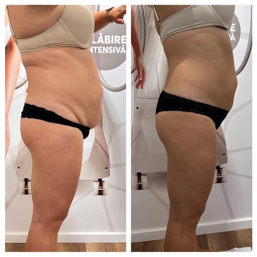 Comparatie before si after, profil corporal